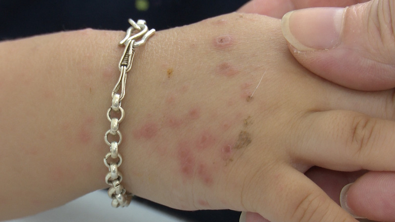 Increasing number of children suffering from hand, foot and mouth disease - Photo 1.