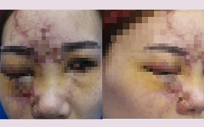 Filler injections disguised as collagen, many people experience complications - Photo 2.