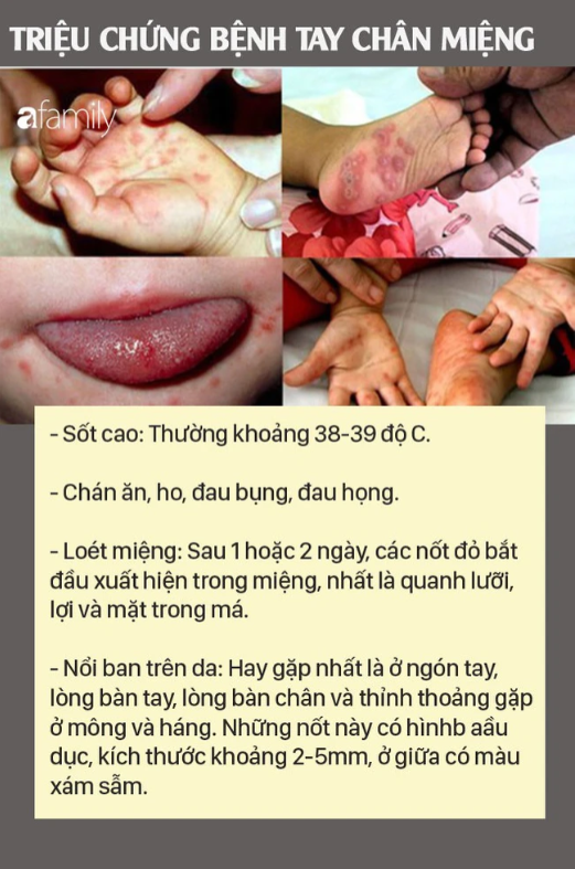 Hand, foot and mouth disease: The disease is highly contagious, signs are easy to ignore, and complications are high - Photo 2.