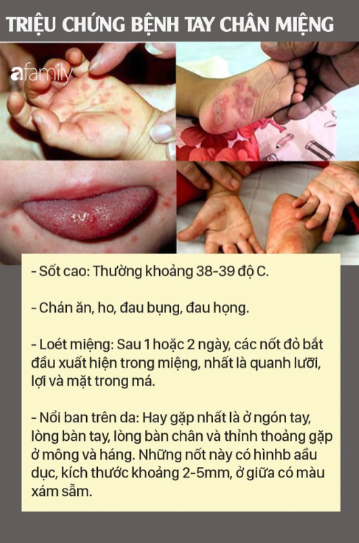 Bệnh tay chân miệng: Căn bệnh lây mạnh, dấu hiệu dễ bỏ qua, biến chứng cao - Ảnh 2.