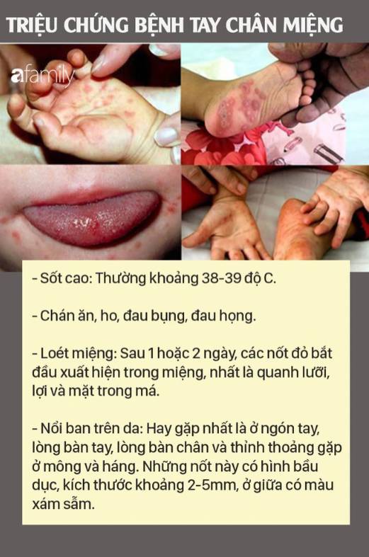 Bệnh tay chân miệng: Căn bệnh lây mạnh, dấu hiệu dễ bỏ qua, biến chứng cao - Ảnh 1.