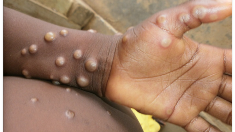 Bộ Y tế khuyến cáo các biện pháp phòng chống bệnh đậu mùa khỉ - Ảnh 1.