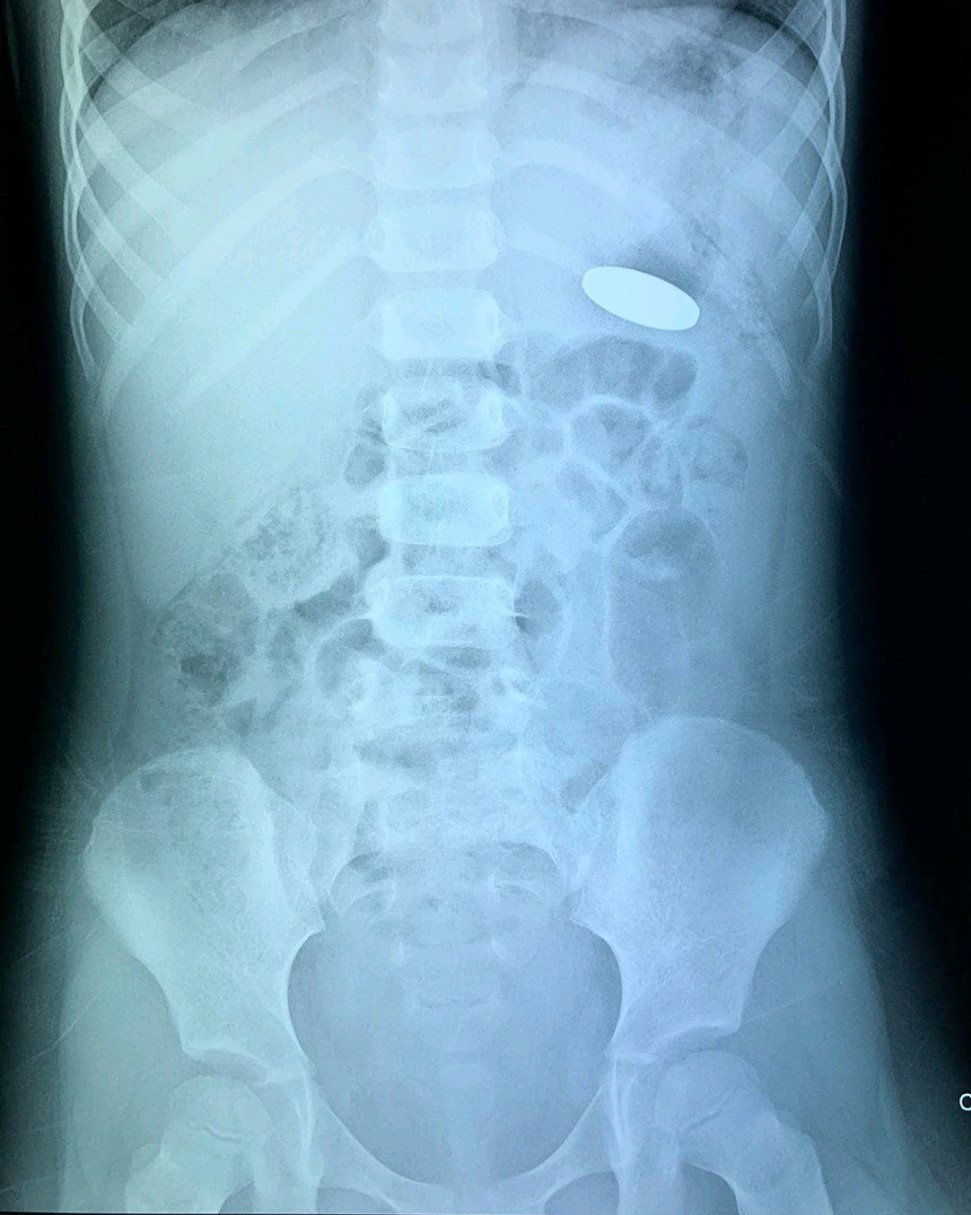 2-month-old baby has difficulty breathing when swallowing a foreign object - Photo 2.