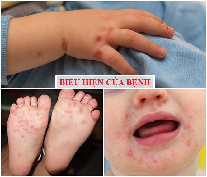 From a case of death due to hand, foot and mouth disease: Mistakes to avoid in treatment and care when children get sick - Photo 2.
