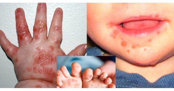 Trẻ có thể bị tay chân miệng và sốt xuất huyết cùng lúc không? Phân biệt vết viêm loét là do tay chân miệng gây ra - Ảnh 1.