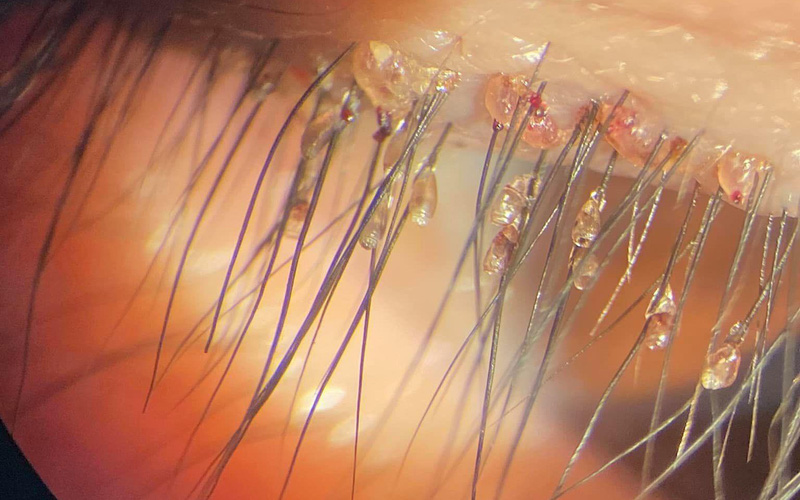 Nearly 100 pubic lice nest on the patient's male eyelid - Photo 1.