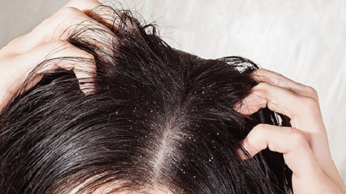 Tóc nhanh bết do đâu và làm sao để khắc phục tình trạng đầu vừa gội đã bết - Ảnh 5.