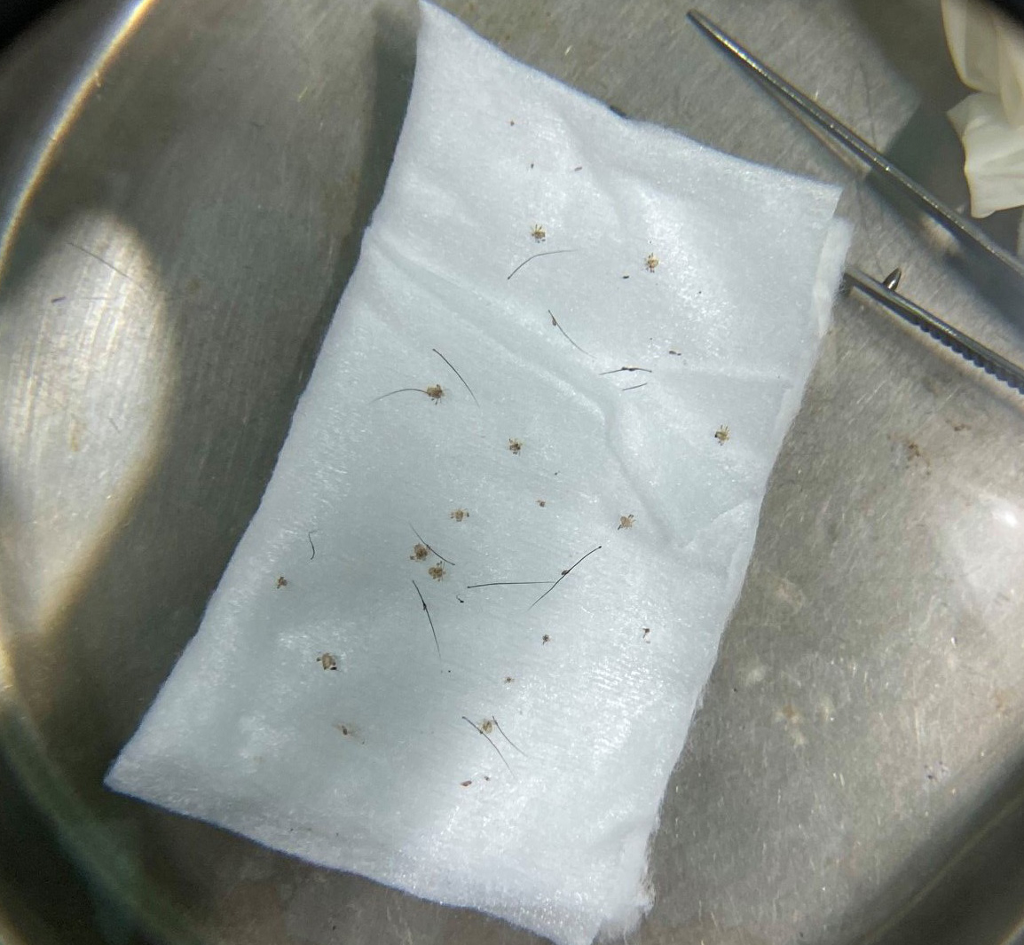 Nearly 100 pubic lice nest on the patient's male eyelid - Photo 2.