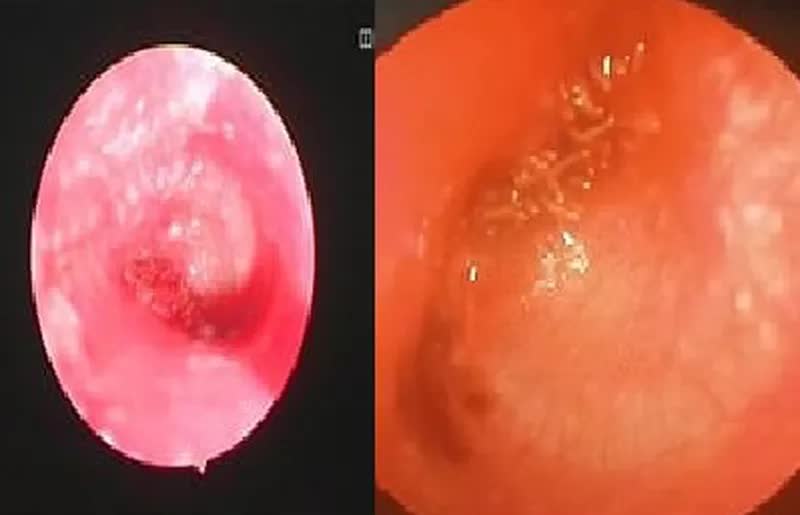 Pick up hundreds of maggots to nest in the patient's ear - Photo 1.