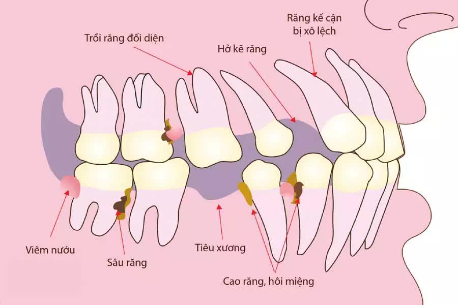 Nhận biết và điều trị tiêu xương và hoại tử xương hàm mặt sớm phòng biến chứng nguy hiểm - Ảnh 4.