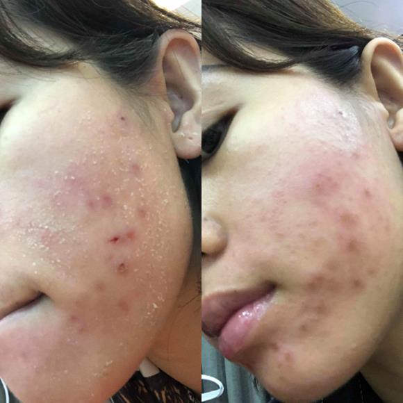 Hành trình doanh nhân Ngô Phương Linh đưa Haki Gingem Acne cải thiện mụn đến người Việt - Ảnh 3.