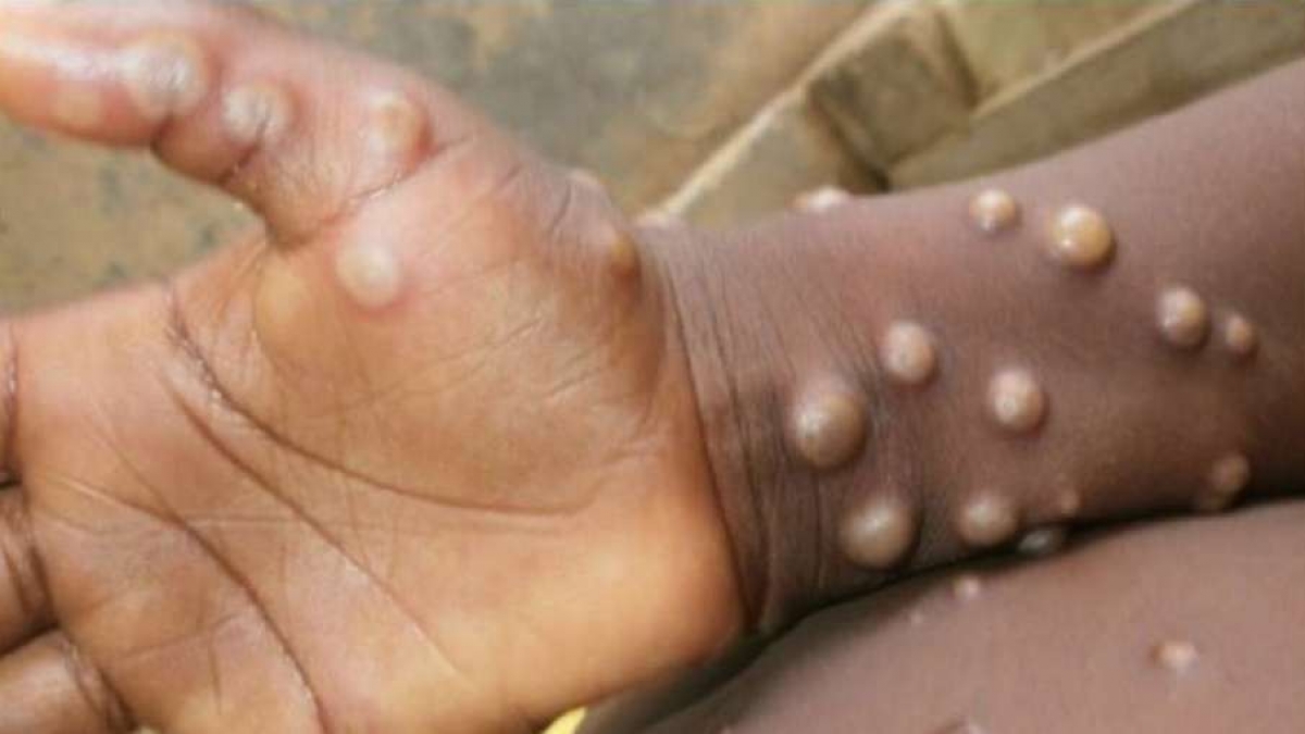 Ấn Độ ghi nhận trường hợp đầu tiên tử vong vì bệnh đậu mùa khỉ - Ảnh 1.