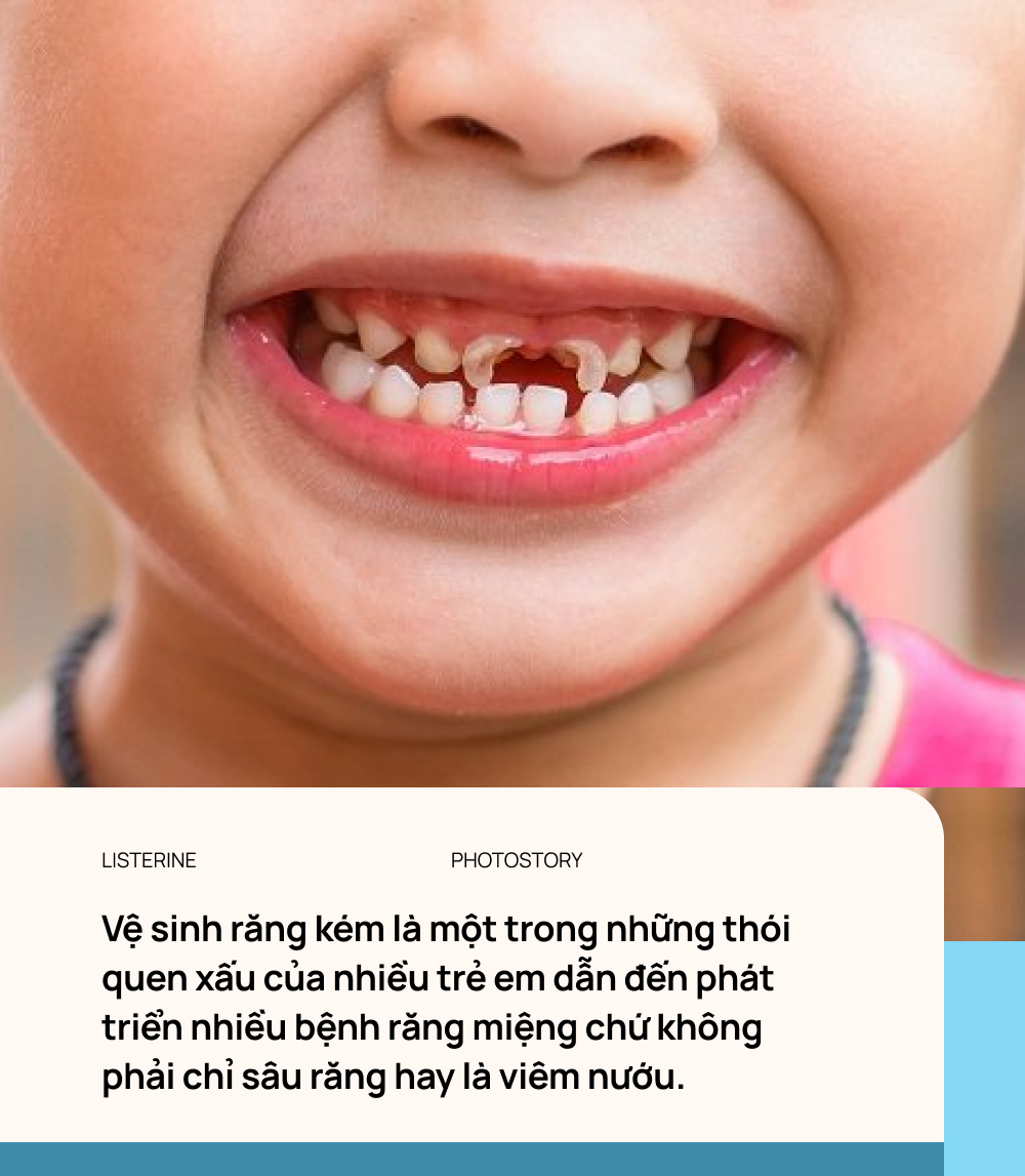 Молочные зубы картинки. Кариес молочных зубов у детей. Кариес молочных зубов черные.