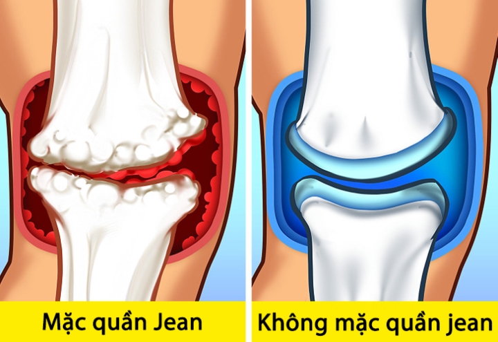 5 hậu quả tai hại khi mặc quần jean bó quá thường xuyên - Ảnh 1.