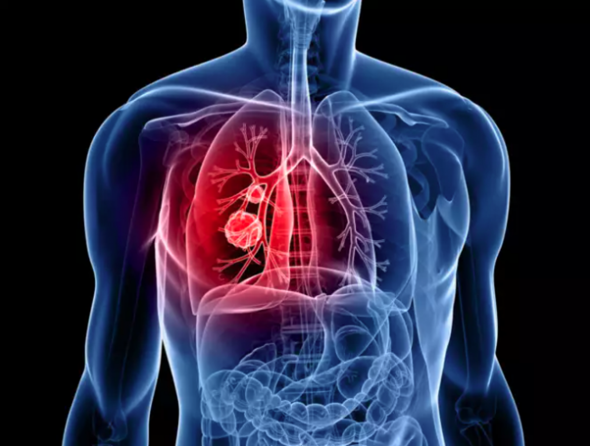 Các triệu chứng ban đầu của bệnh ung thư phổi cần đề phòng - Ảnh 2.