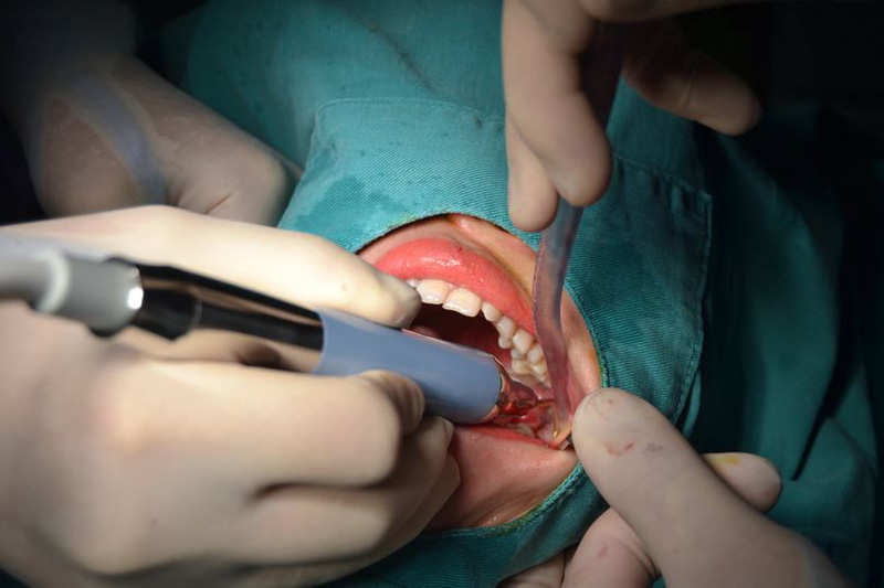 Áp xe vùng mặt - Hậu quả nặng nề khi chủ quan với biến chứng mọc răng khôn - Ảnh 1.