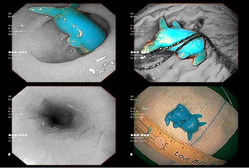 Bé 6 tuổi phải nhập viện vì món đồ chơi mắc kẹt ở thực quản - Ảnh 1.
