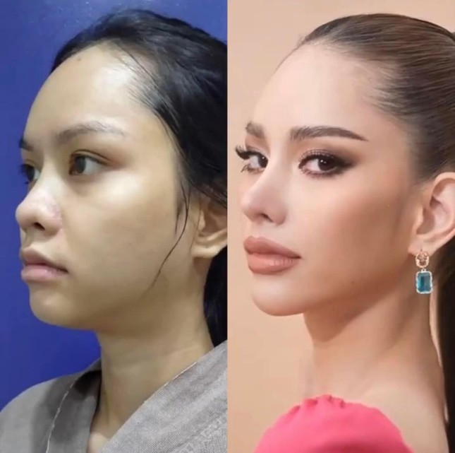 Tân Hoa hậu Hoàn vũ Thái Lan 2022 lộ ảnh trước khi phẫu thuật thẩm mỹ - Ảnh 3.