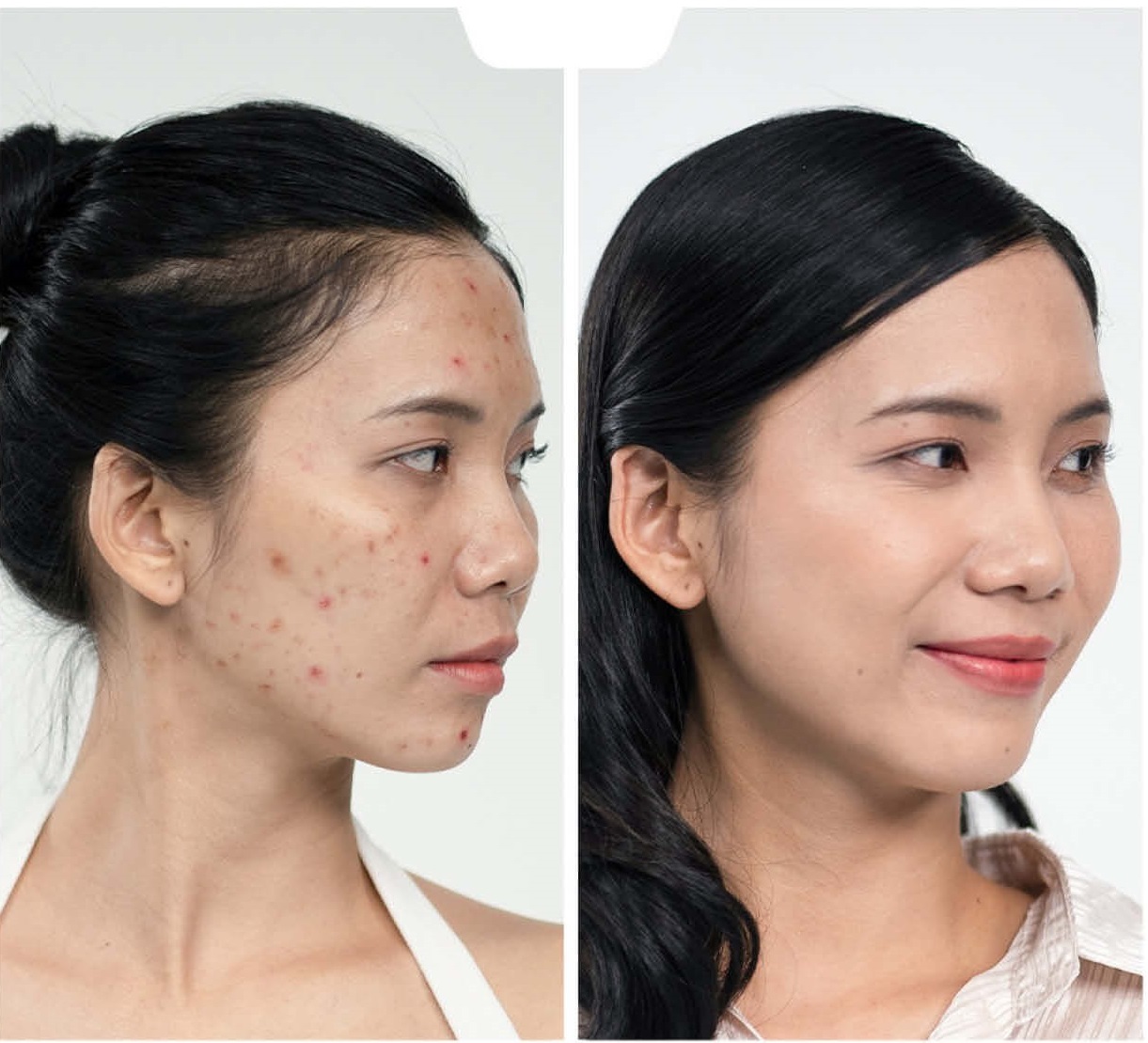 Thanh lăn mụn Ms Cosmetic hỗ trợ đẩy l&ugrave;i th&acirc;m mụn hiệu quả - Ảnh 4.