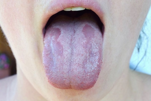 Lưỡi bỗng xuất hiện đốm trắng có thể là dấu hiệu của 3 thứ bệnh, đặc biệt là loại ung thư nguy hiểm này - Ảnh 1.