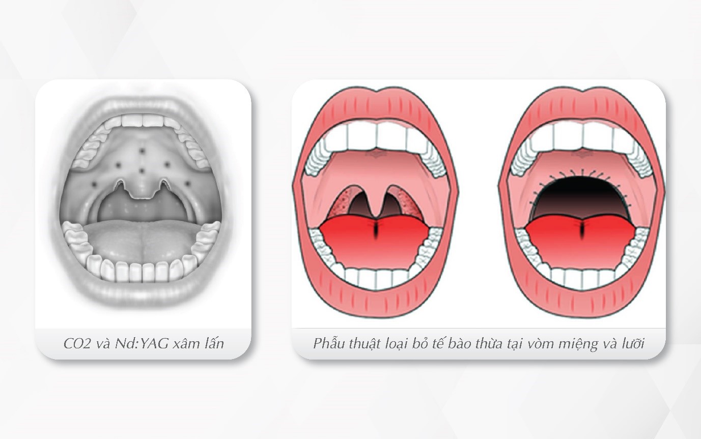 Tìm kiếm giải pháp điều trị ngáy với công nghệ laser không xâm lấn - Ảnh 2.