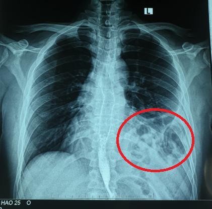 Tưởng bị hậu COVID-19, đi khám mới biết vỡ cơ hoành, dạ dày, lách, đại tràng 'chui hết' lên phổi - Ảnh 3.