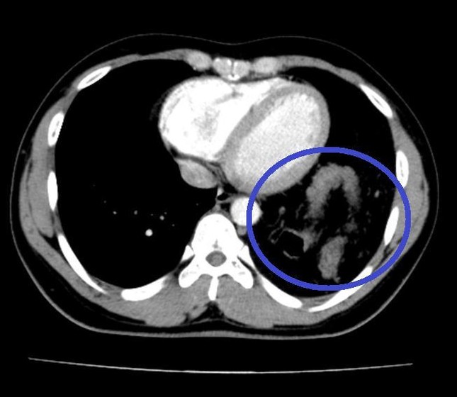 Tưởng bị hậu COVID-19, đi khám mới biết vỡ cơ hoành, dạ dày, lách, đại tràng 'chui hết' lên phổi - Ảnh 2.