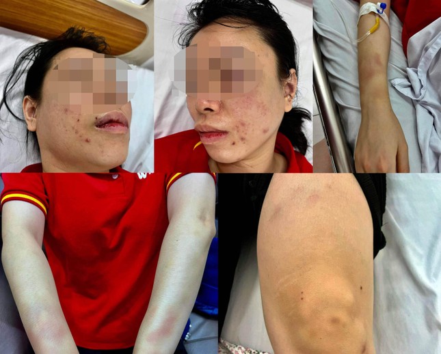 Vụ người phụ nữ ở Hà Nội tố bị &quot;bắt cóc&quot;, đánh đập dã man: Chồng cũ nạn nhân khai nhận hành vi - Ảnh 2.