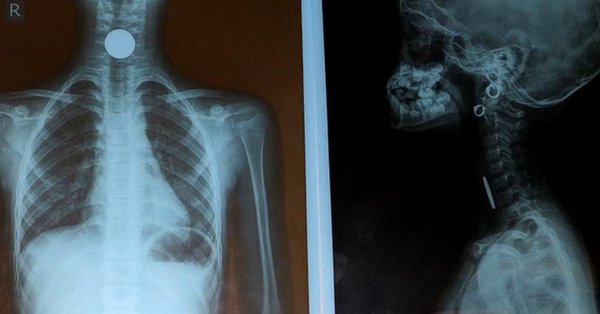 2 việc cần làm ngay khi trẻ bị hóc dị vật