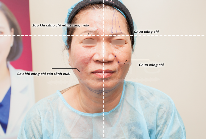 3 tiêu chí vàng để làm đẹp bằng phương pháp căng chỉ thẩm mỹ - Ảnh 2. 3 tiêu chí vàng để làm đẹp bằng phương pháp căng chỉ thẩm mỹ - Ảnh 2.