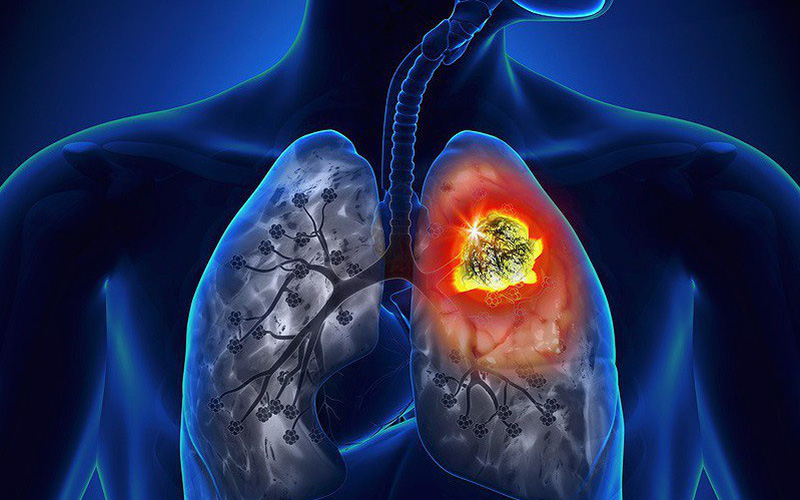Phát hiện khối u ác tính ở phổi sau thời gian dài bị ho - Ảnh 1.
