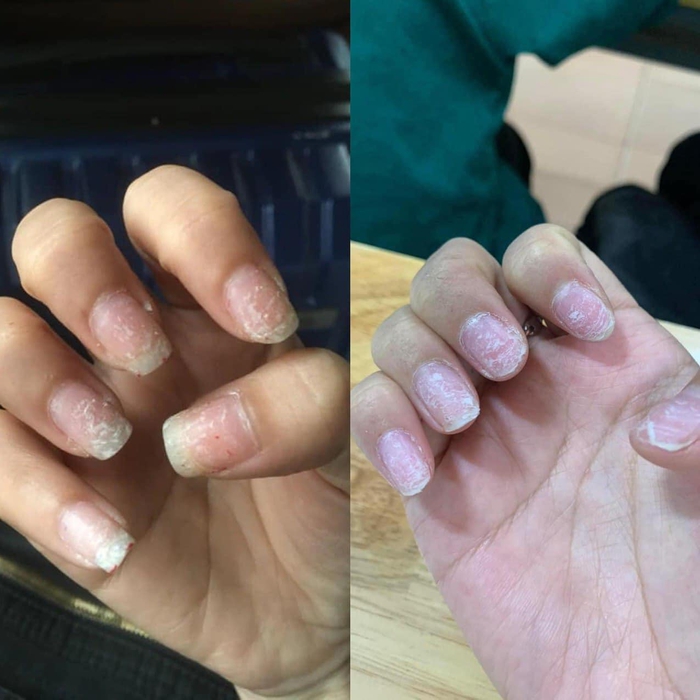 Tình trạng chung của chị em sau Tết: Làm nail hết mình, tháo nail hết hồn - Ảnh 1.