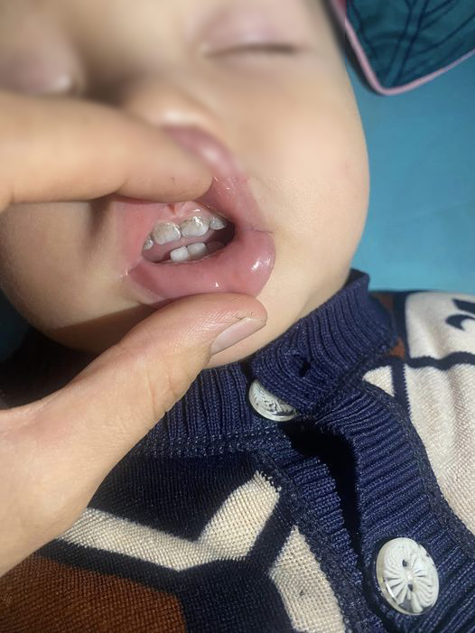 Cách khắc phục tình trạng răng trẻ bị đen khi uống sắt nước? - Ảnh 1.