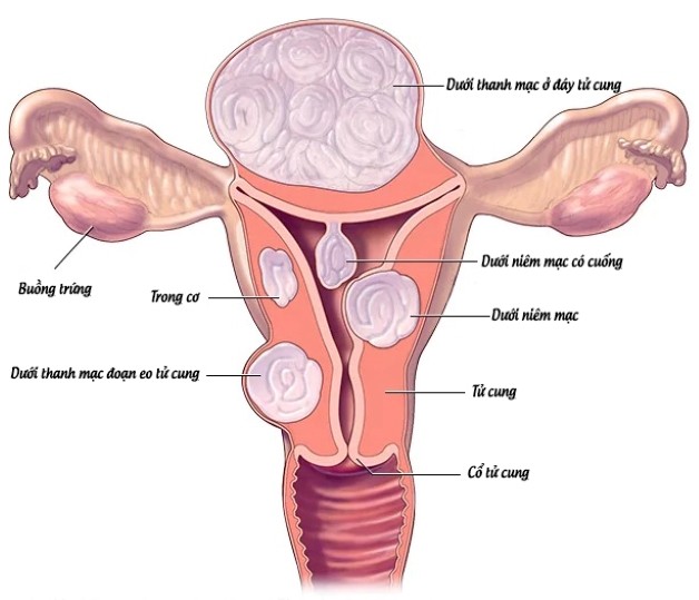 Phát hiện những bất thường này cần đi khám u tử cung ngay lập tức - Ảnh 1.