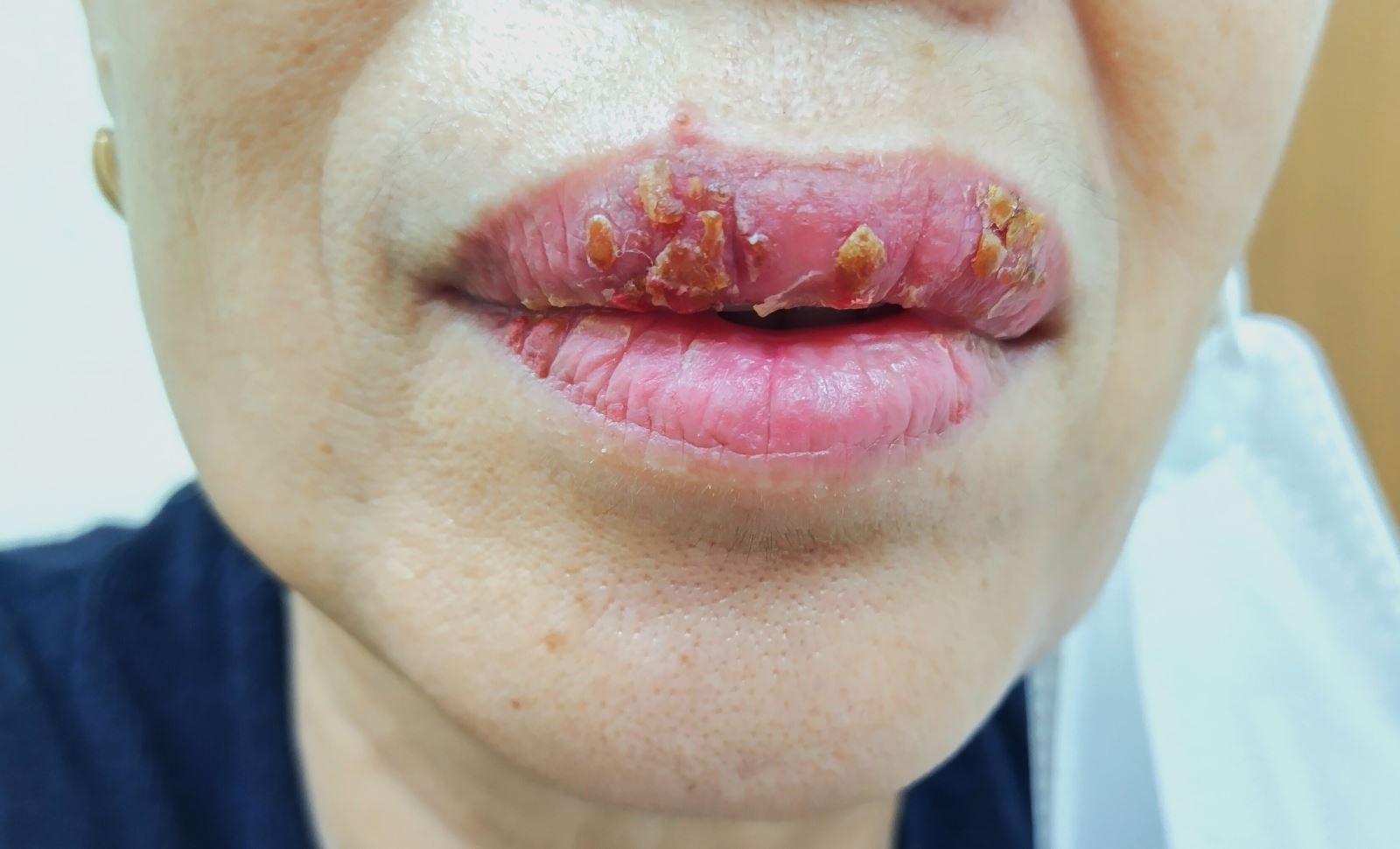 Xăm môi có được ăn măng không Thẩm mỹ Thu Cúc #35 Xăm môi có được ăn măng không Thẩm mỹ Thu Cúc
