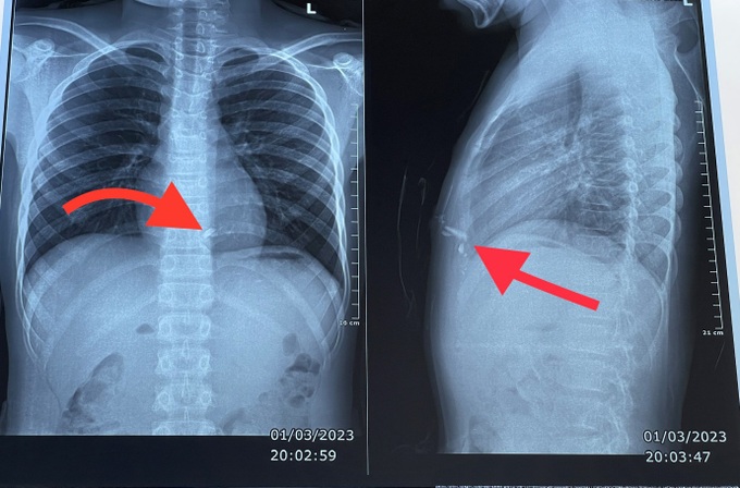 Pháo tự chế phát nổ khiến thiếu niên 14 tuổi bỏng mặt, 2 tay và chân, nghi tổn thương tim - Ảnh 1. Pháo tự chế phát nổ khiến thiếu niên 14 tuổi bỏng mặt, 2 tay và chân, nghi tổn thương tim - Ảnh 1.