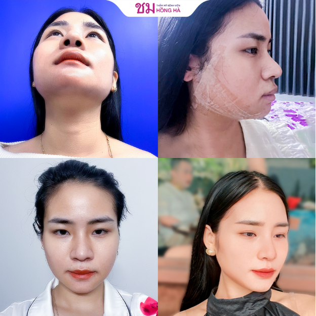 Chuyên khoa thẩm mỹ Hồng Hà - Kiến tạo nhan sắc toàn diện không phân biệt giới tính - Ảnh 7. Chuyên khoa thẩm mỹ Hồng Hà - Kiến tạo nhan sắc toàn diện không phân biệt giới tính - Ảnh 7.