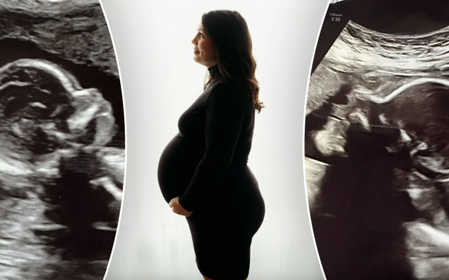 Kỳ lạ người phụ nữ có hai tử cung mang thai đôi, mỗi tử cung một thai nhi - Ảnh 1.