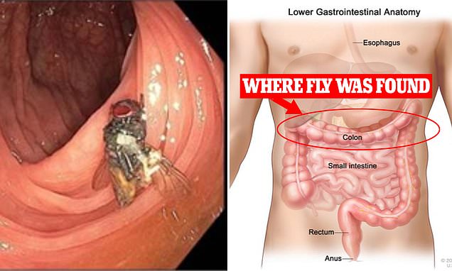 Phát hiện côn trùng sống trong ruột người đàn ông ở Mỹ - Ảnh 1.