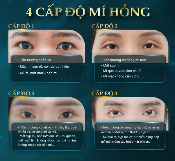 Gợi ý chuyên gia khắc phục nỗi lo mí hỏng - Ảnh 3. Gợi ý chuyên gia khắc phục nỗi lo mí hỏng - Ảnh 3.