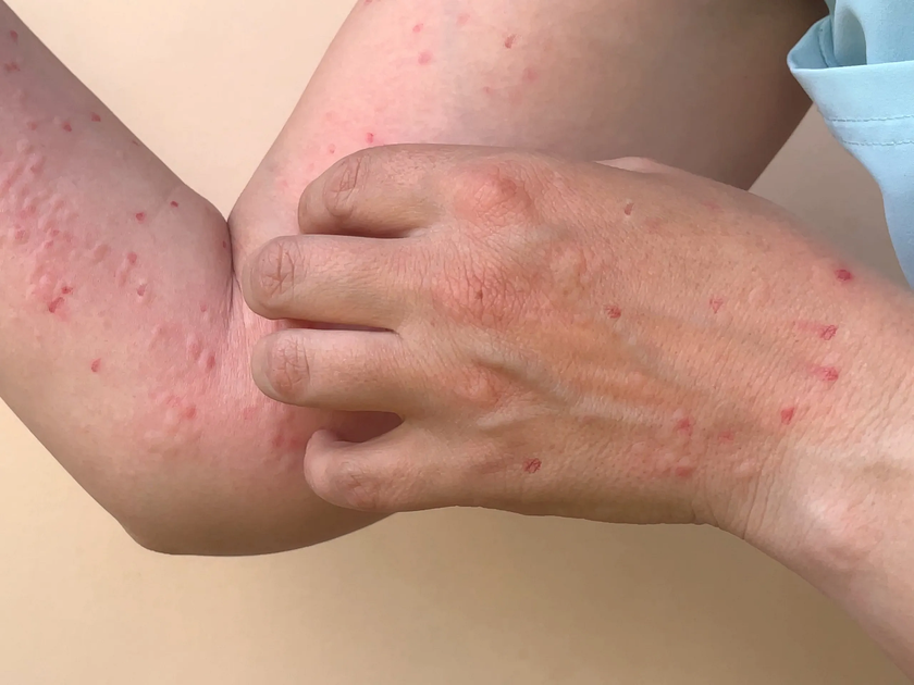 7 địa phương ghi nhận 56 ca nhiễm đậu m&ugrave;a khỉ - Ảnh 1.