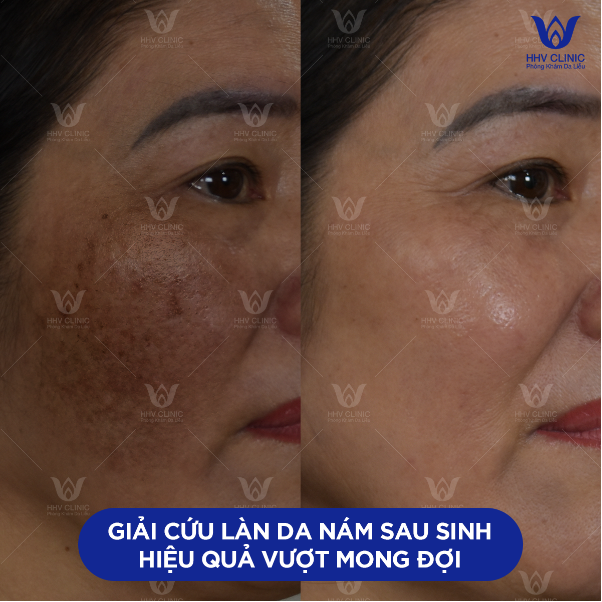 Phòng khám da liễu HHV Clinic - Địa chỉ tham khảo trị mụn đúng cách - Ảnh 2. Phòng khám da liễu HHV Clinic - Địa chỉ tham khảo trị mụn đúng cách - Ảnh 2.