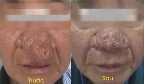 Người đàn ông bị mũi sư tử - Ảnh 2. Người đàn ông bị mũi sư tử - Ảnh 2.
