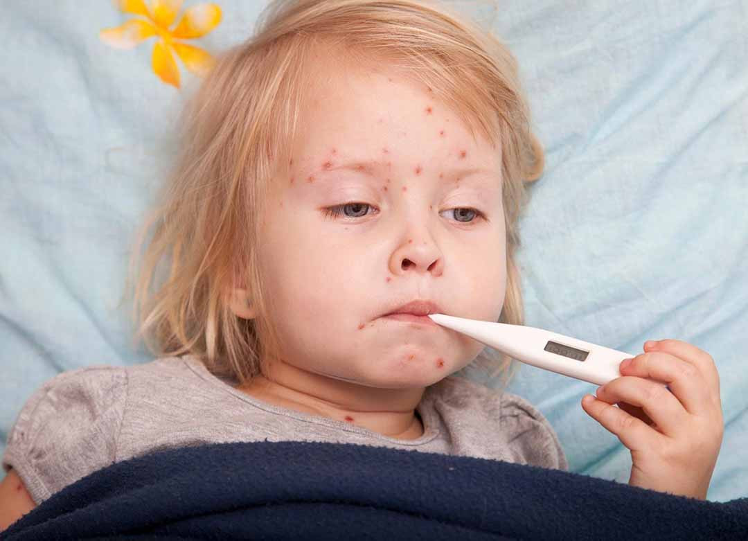 Nhận biết dấu hiệu sốt xuất huyết ở trẻ nhỏ - Ảnh 3.