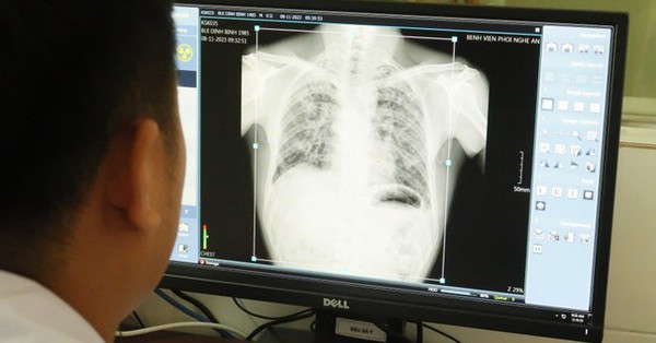 Vụ 6 người tử vong do bụi phổi ở Nghệ An: Phát hiện thêm 57 người mắc bệnh - Ảnh 1.