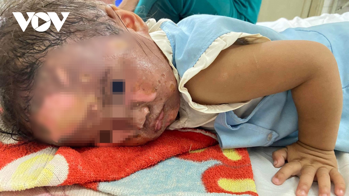 Bé gái 2 tuổi ở Bình Dương ngã úp mặt vào tô mì bỏng nặng - Ảnh 1.