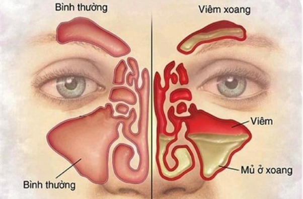 Biến chứng khó lường của viêm xoang mạn tính - Ảnh 1. Biến chứng khó lường của viêm xoang mạn tính - Ảnh 1.