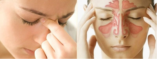 Biến chứng khó lường của viêm xoang mạn tính - Ảnh 3. Biến chứng khó lường của viêm xoang mạn tính - Ảnh 3.