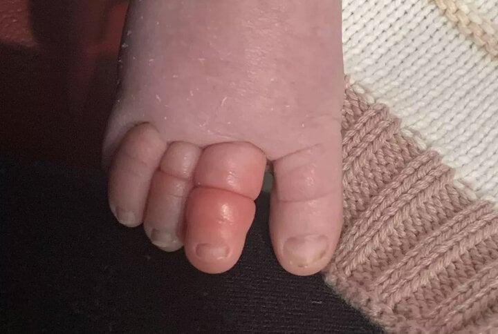 Em bé sơ sinh suýt mất ngón chân chỉ vì sợi tóc của mẹ - Ảnh 2.