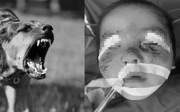 B&eacute; 3 tuổi bị ch&oacute; h&agrave;ng x&oacute;m cắn trọng thương - Ảnh 1.